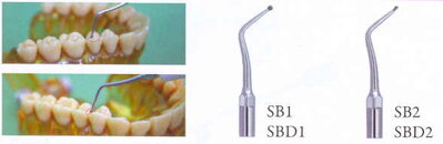 SB1.SB2.SBD1.SBD2 koncovka UOZK na preparáciu cavity